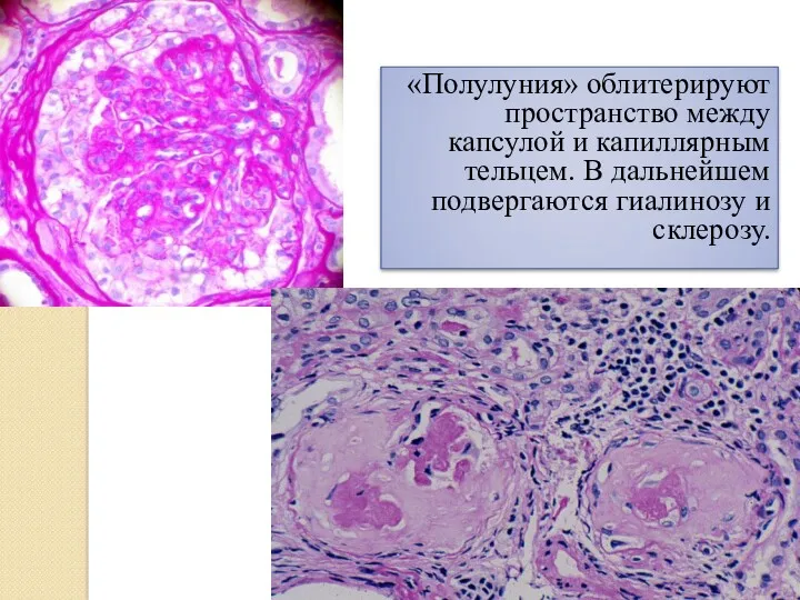 «Полулуния» облитерируют пространство между капсулой и капиллярным тельцем. В дальнейшем подвергаются гиалинозу и склерозу.