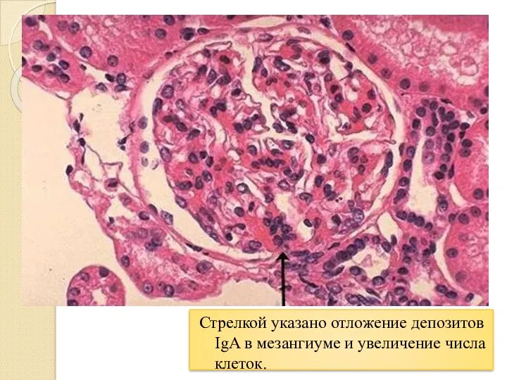 Стрелкой указано отложение депозитов IgA в мезангиуме и увеличение числа клеток.