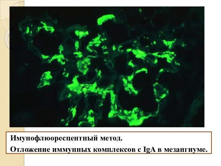 Имунофлюоресцентный метод. Отложение иммунных комплексов с IgA в мезангиуме.