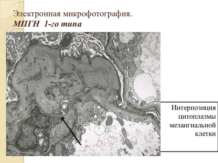 Электронная микрофотография. МПГН 1-го типа Интерпозиция цитоплазмы мезангиальной клетки