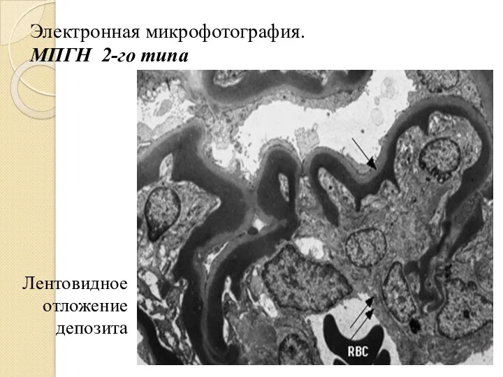 Электронная микрофотография. МПГН 2-го типа Лентовидное отложение депозита