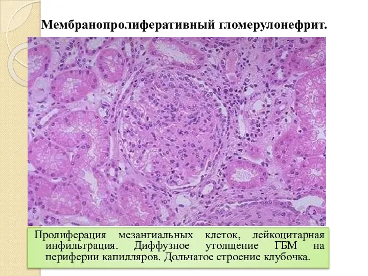 Мембранопролиферативный гломерулонефрит. Пролиферация мезангиальных клеток, лейкоцитарная инфильтрация. Диффузное утолщение ГБМ на периферии капилляров. Дольчатое строение клубочка.