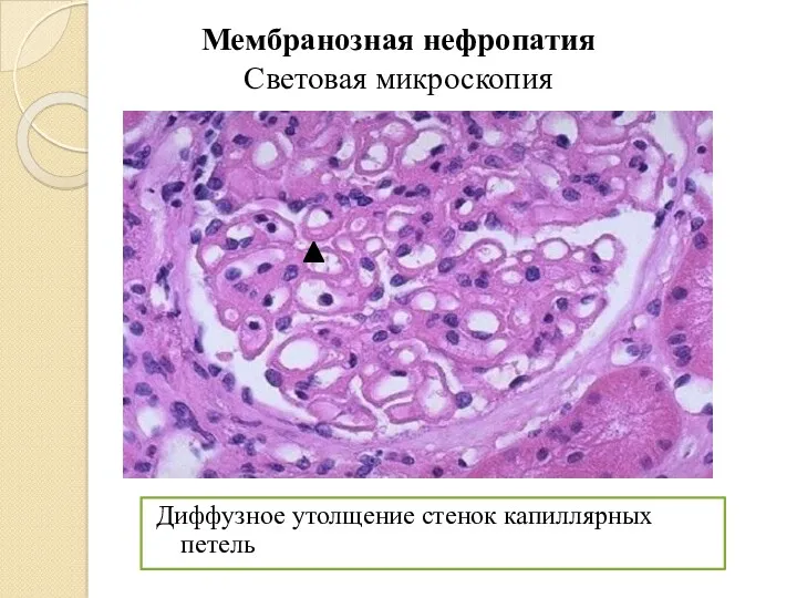 Мембранозная нефропатия Световая микроскопия Диффузное утолщение стенок капиллярных петель