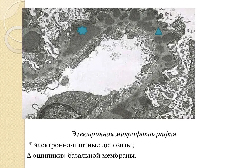 Электронная микрофотография. * электронно-плотные депозиты; Δ «шипики» базальной мембраны.