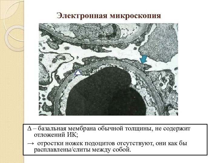 Электронная микроскопия Δ – базальная мембрана обычной толщины, не содержит