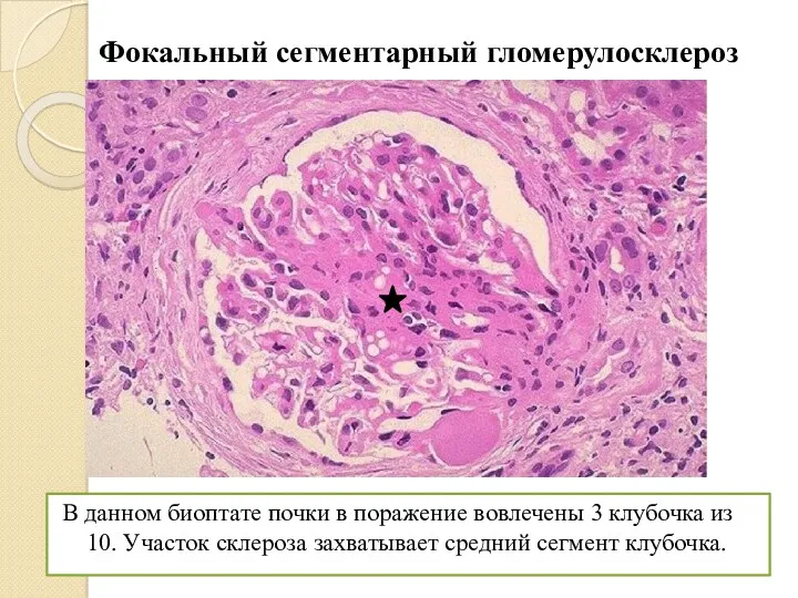 Фокальный сегментарный гломерулосклероз В данном биоптате почки в поражение вовлечены