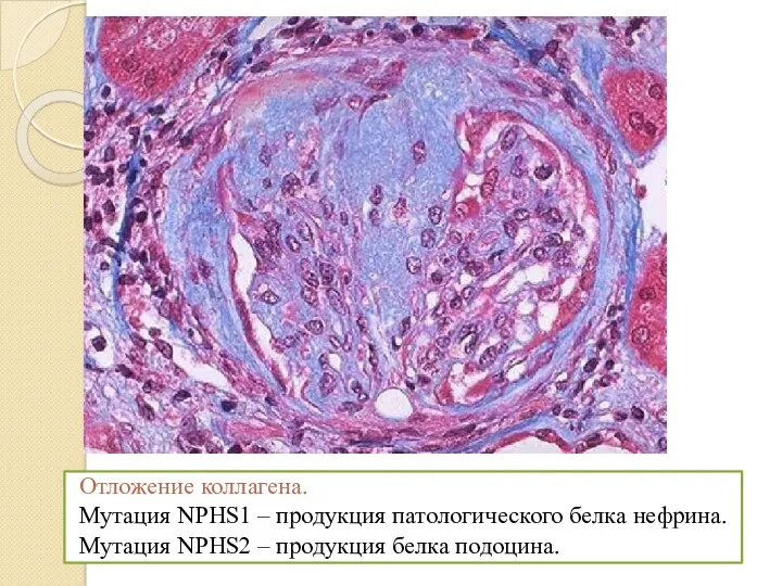 Отложение коллагена. Мутация NPHS1 – продукция патологического белка нефрина. Мутация NPHS2 – продукция белка подоцина.