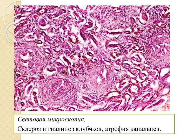 Световая микроскопия. Склероз и гиалиноз клубчков, атрофия канальцев.