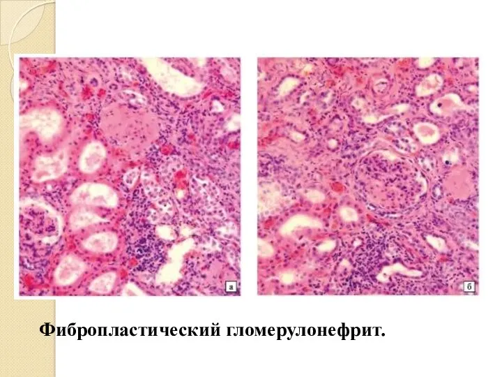 Фибропластический гломерулонефрит.