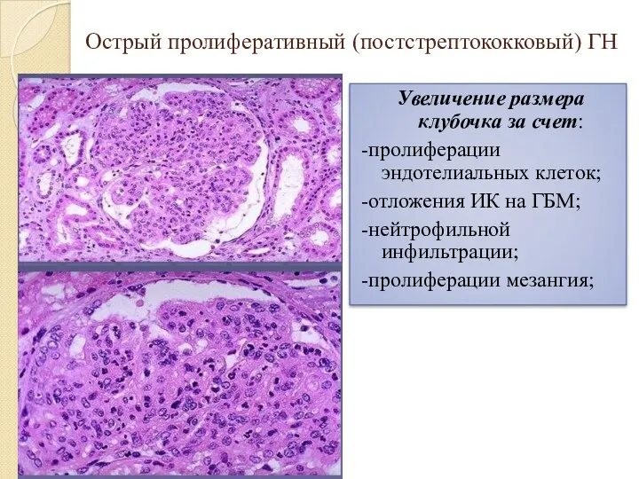 Острый пролиферативный (постстрептококковый) ГН Увеличение размера клубочка за счет: -пролиферации