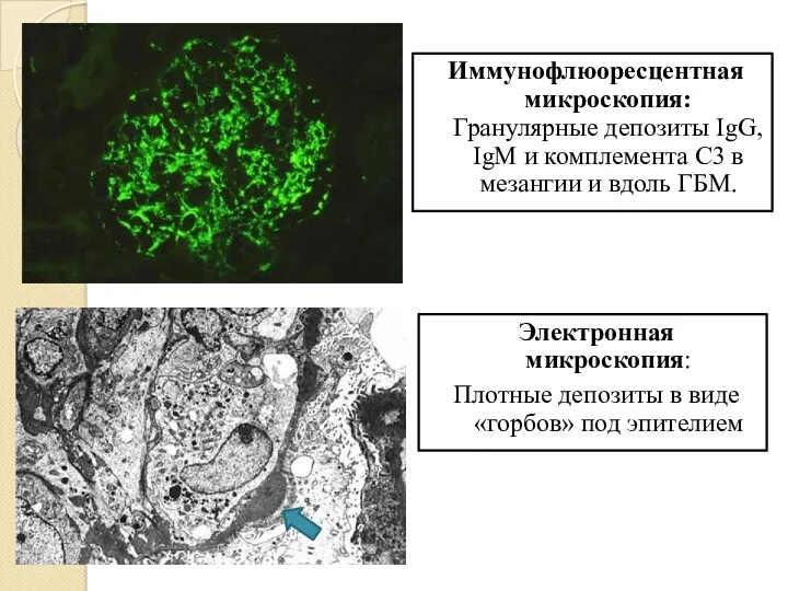 Электронная микроскопия: Плотные депозиты в виде «горбов» под эпителием Иммунофлюоресцентная