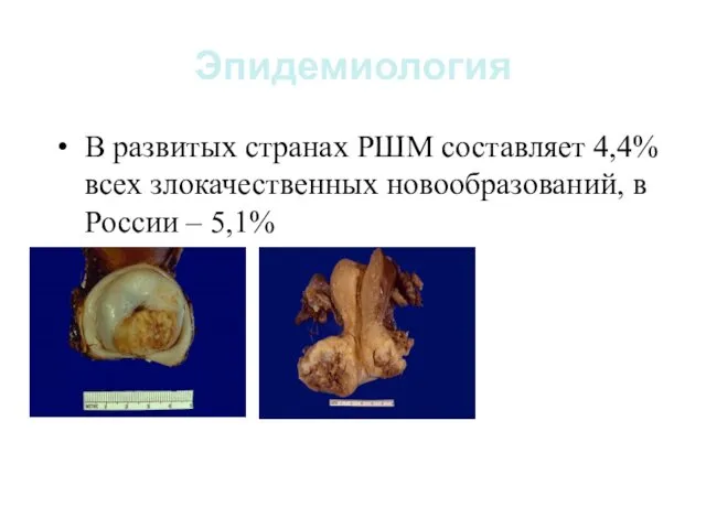 Эпидемиология В развитых странах РШМ составляет 4,4% всех злокачественных новообразований, в России – 5,1%