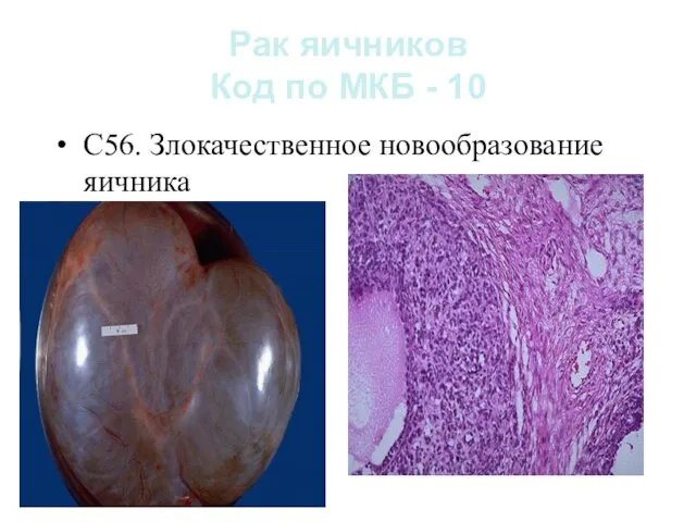 Рак яичников Код по МКБ - 10 С56. Злокачественное новообразование яичника