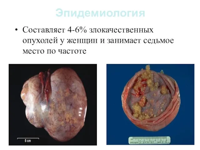 Эпидемиология Составляет 4-6% злокачественных опухолей у женщин и занимает седьмое место по частоте