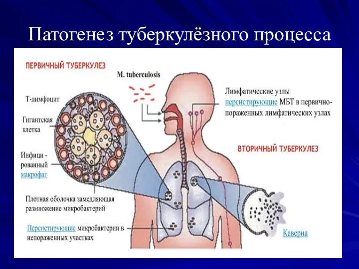 Патогенез туберкулёзного процесса