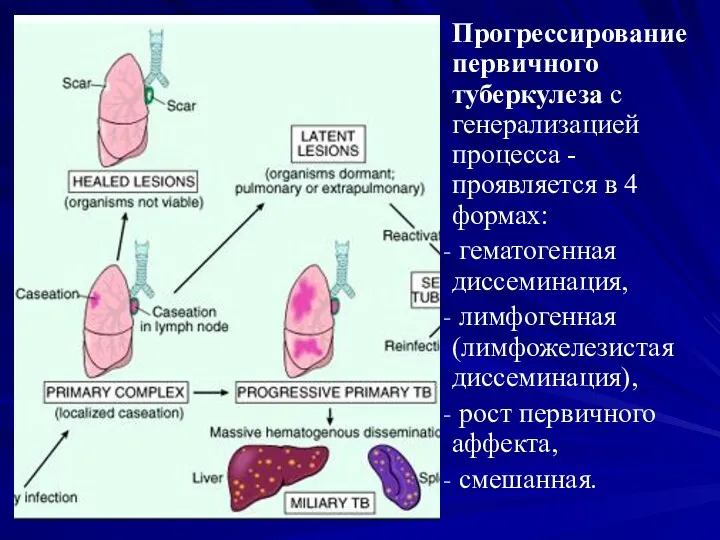 Прогрессирование первичного туберкулеза с генерализацией процесса - проявляется в 4