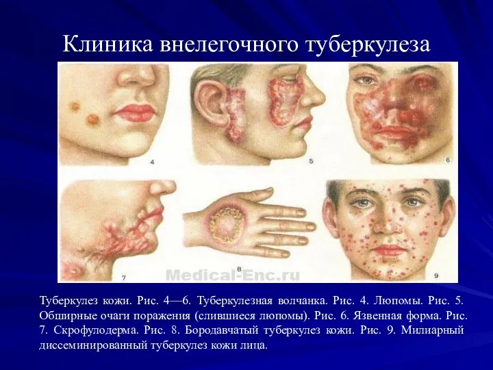 Клиника внелегочного туберкулеза Туберкулез кожи. Рис. 4—6. Туберкулезная волчанка. Рис.