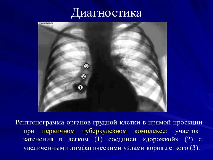 Диагностика Рентгенограмма органов грудной клетки в прямой проекции при первичном