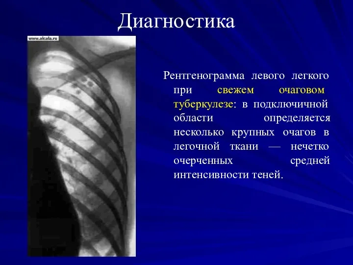 Диагностика Рентгенограмма левого легкого при свежем очаговом туберкулезе: в подключичной