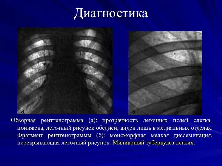 Диагностика Обзорная рентгенограмма (а): прозрачность легочных полей слегка понижена, легочный