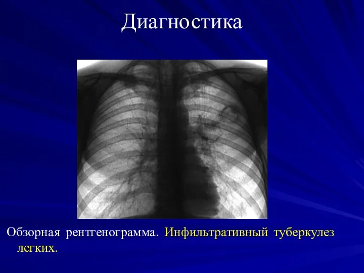 Диагностика Обзорная рентгенограмма. Инфильтративный туберкулез легких.