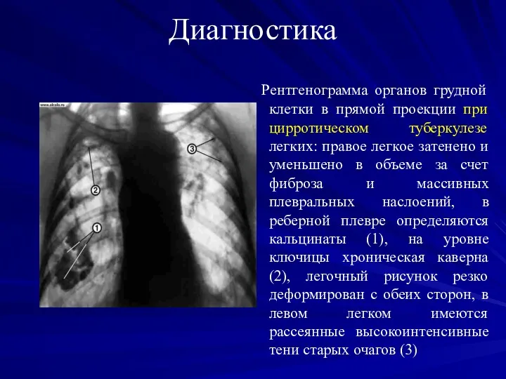 Диагностика Рентгенограмма органов грудной клетки в прямой проекции при цирротическом