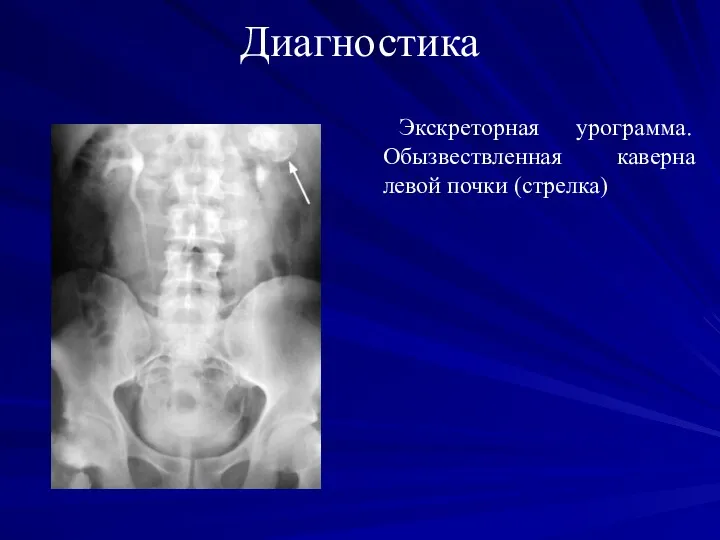 Диагностика Экскреторная урограмма. Обызвествленная каверна левой почки (стрелка)