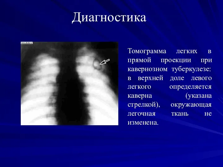Диагностика Томограмма легких в прямой проекции при кавернозном туберкулезе: в