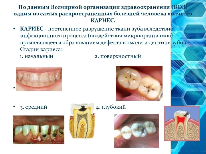КАРИЕС - постепенное разрушение ткани зуба вследствие инфекционного процесса (воздействия