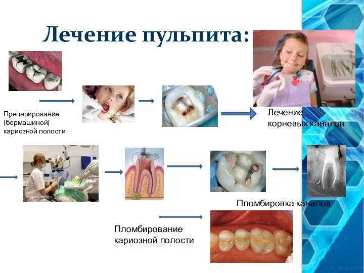 Лечение пульпита: Лечение корневых каналов Пломбировка каналов Препарирование (бормашиной) кариозной полости Пломбирование кариозной полости