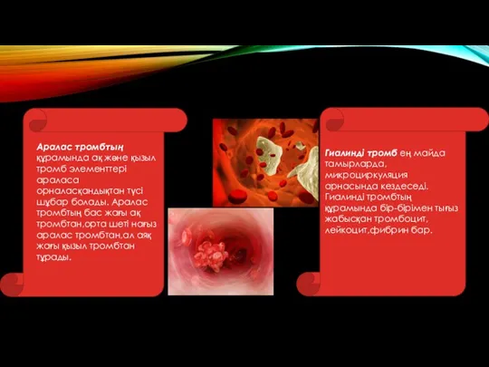 Аралас тромбтың құрамында ақ және қызыл тромб элементтері араласа орналасқандықтан