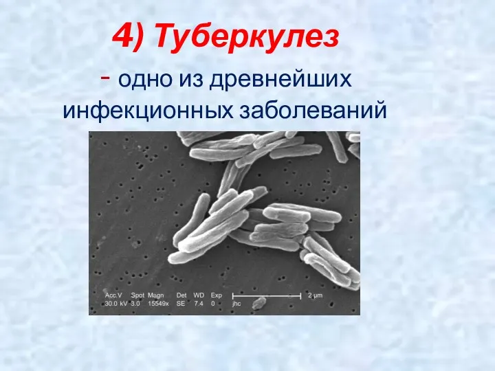 4) Туберкулез - одно из древнейших инфекционных заболеваний