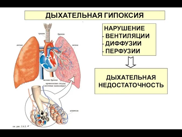 ДЫХАТЕЛЬНАЯ ГИПОКСИЯ НАРУШЕНИЕ ВЕНТИЛЯЦИИ ДИФФУЗИИ ПЕРФУЗИИ ДЫХАТЕЛЬНАЯ НЕДОСТАТОЧНОСТЬ