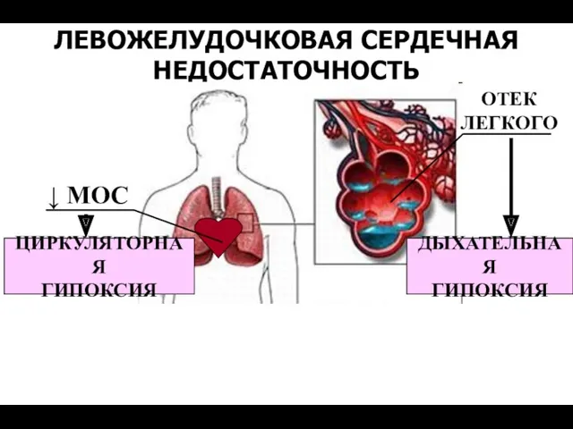 ЛЕВОЖЕЛУДОЧКОВАЯ СЕРДЕЧНАЯ НЕДОСТАТОЧНОСТЬ ↓ МОС ЦИРКУЛЯТОРНАЯ ГИПОКСИЯ ОТЕК ЛЕГКОГО ДЫХАТЕЛЬНАЯ ГИПОКСИЯ