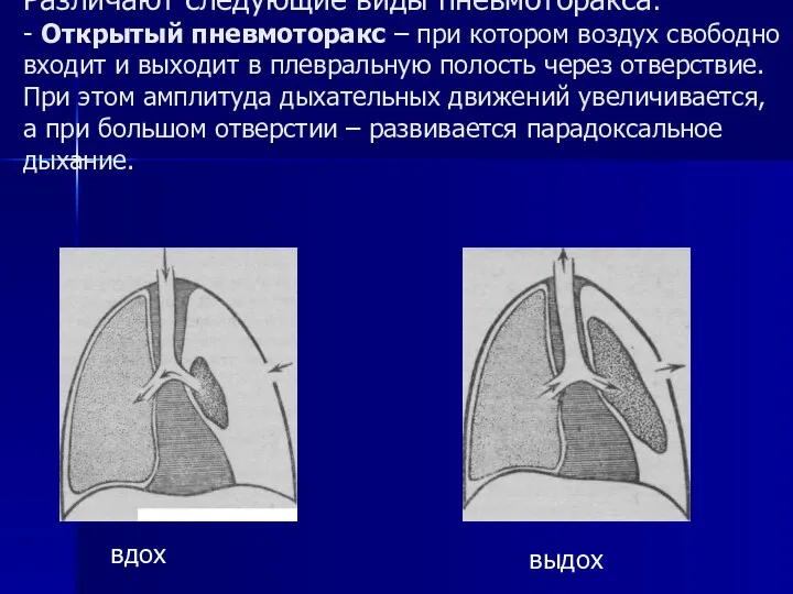 Различают следующие виды пневмоторакса: - Открытый пневмоторакс – при котором