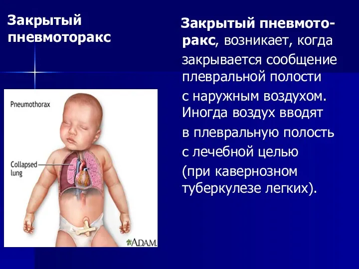 Закрытый пневмото-ракс, возникает, когда закрывается сообщение плевральной полости с наружным