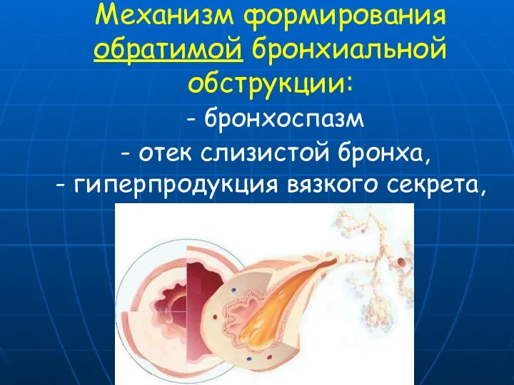 Механизм формирования обратимой бронхиальной обструкции: - бронхоспазм - отек слизистой бронха, - гиперпродукция вязкого секрета,