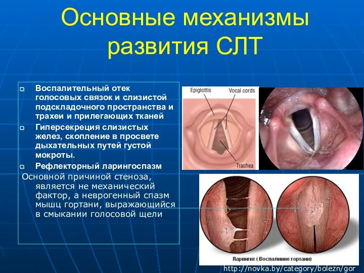 Основные механизмы развития СЛТ Воспалительный отек голосовых связок и слизистой