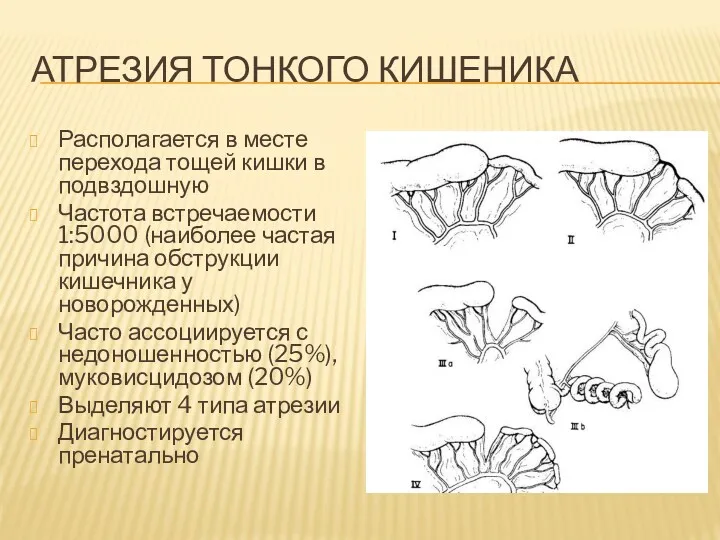 АТРЕЗИЯ ТОНКОГО КИШЕНИКА Располагается в месте перехода тощей кишки в