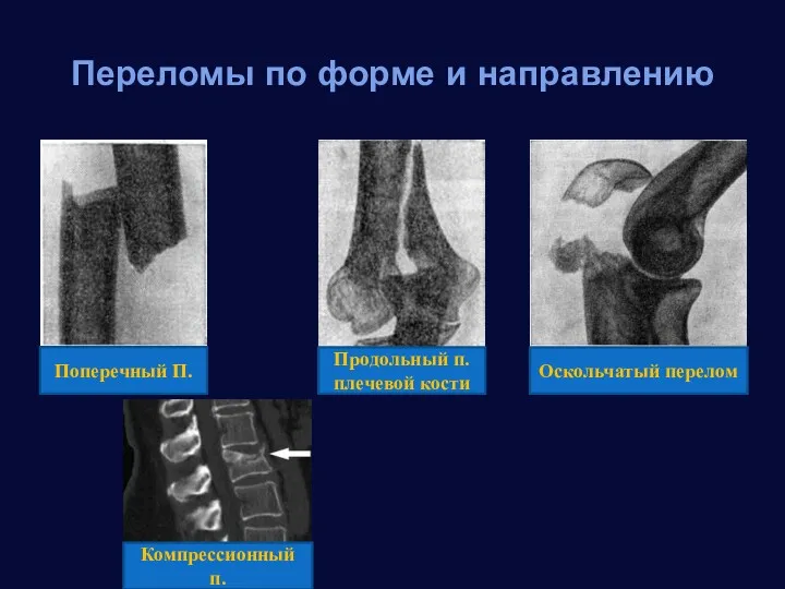Переломы по форме и направлению Поперечный П. Оскольчатый перелом Продольный п. плечевой кости Компрессионный п.