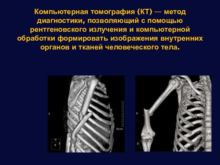 Компьютерная томография (КТ) — метод диагностики, позволяющий с помощью рентгеновского