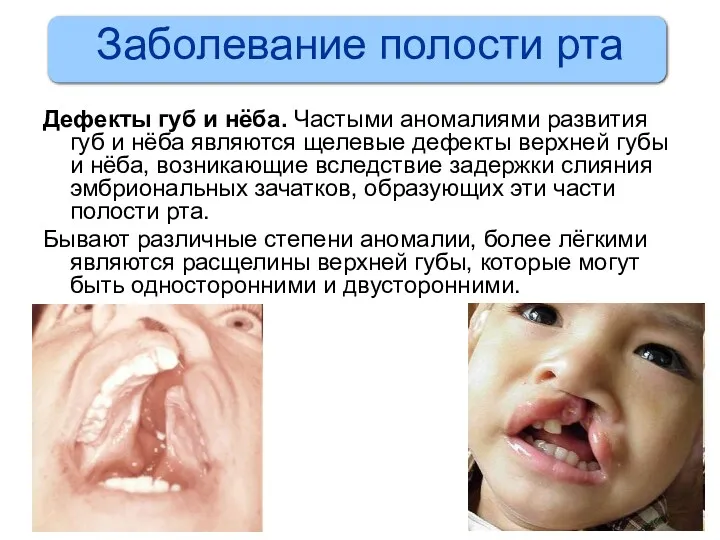 Заболевание полости рта Дефекты губ и нёба. Частыми аномалиями развития