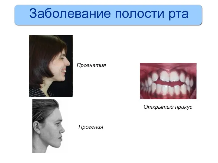 Прогнатия Прогения Открытый прикус Заболевание полости рта