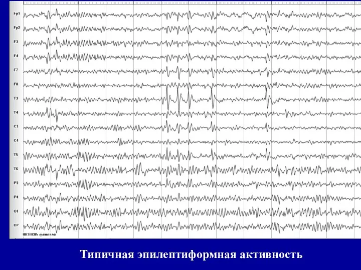 Типичная эпилептиформная активность