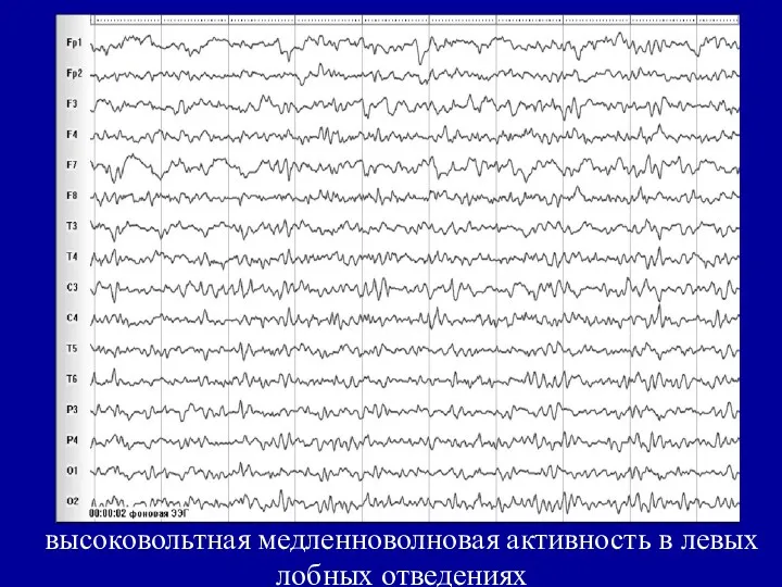 высоковольтная медленноволновая активность в левых лобных отведениях