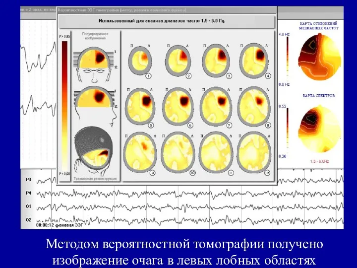 Методом вероятностной томографии получено изображение очага в левых лобных областях