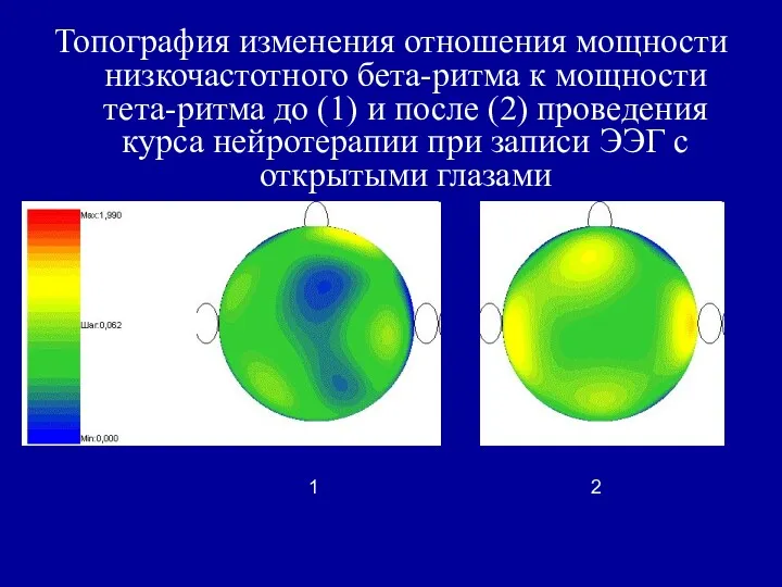 Топография изменения отношения мощности низкочастотного бета-ритма к мощности тета-ритма до (1) и после