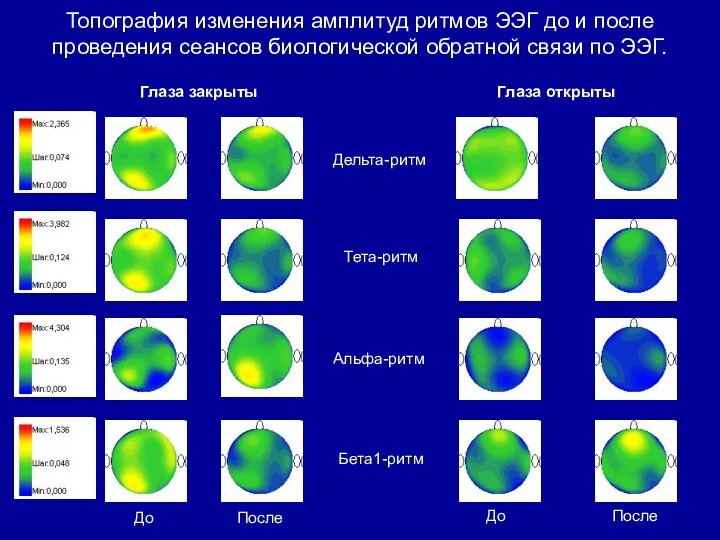 Топография изменения амплитуд ритмов ЭЭГ до и после проведения сеансов биологической обратной связи