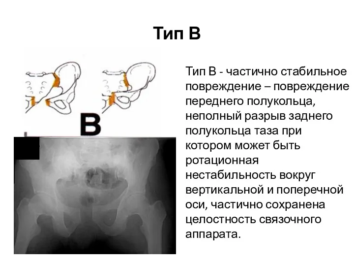 Тип В Тип В - частично стабильное повреждение – повреждение