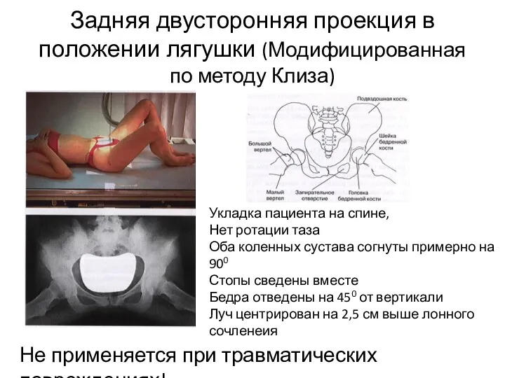 Задняя двусторонняя проекция в положении лягушки (Модифицированная по методу Клиза)